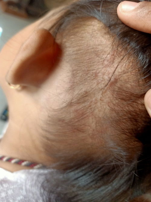 Gatal biang keringat