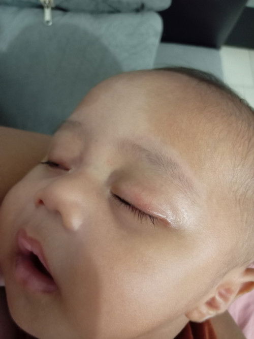 Warna wajah anakku gak merata