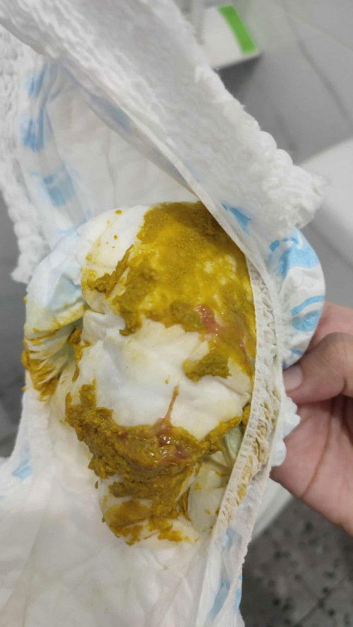 Ano kaya tong kulay red sa dumi ni baby? ngayong araw sya dumumi ng madalas