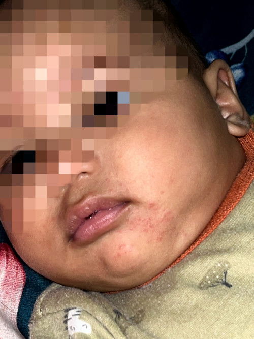 Ruam pada sekitar kulit, bintik kecil merah banyak