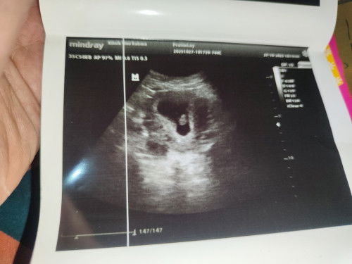 Usg kembar atau bukan