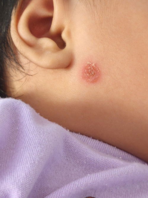 Luka dekat pipi makin merebak