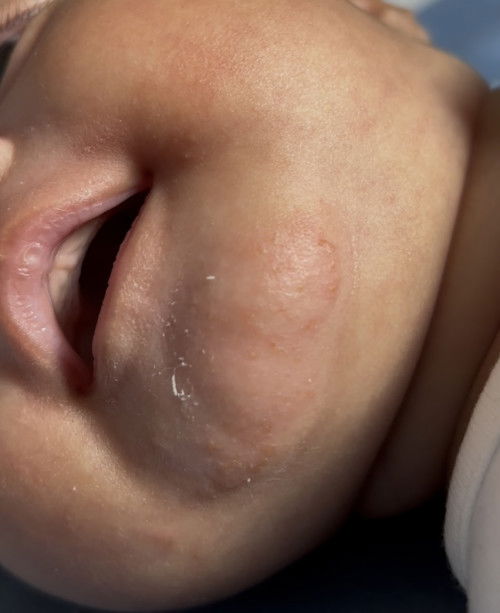 Ni ruam susu ke eczema?