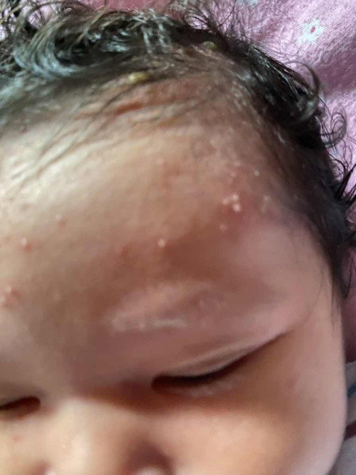 Tips mengatasi bisul pada bayi