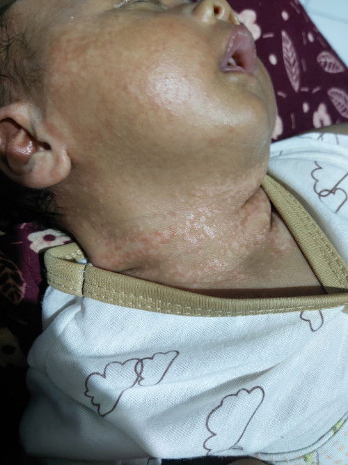 Cara ngilangin bekas biang keringat