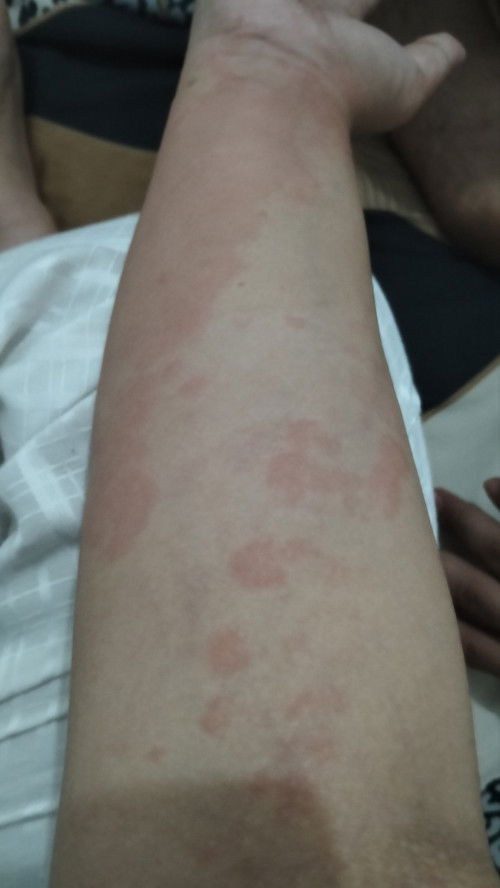 Bunda ada gak disini ibu hamil yg kaligata ? Info obat nya yg aman untuk bumil