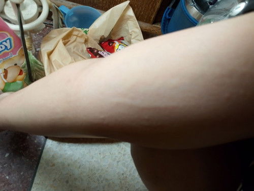 ผื่นหลังคลอด