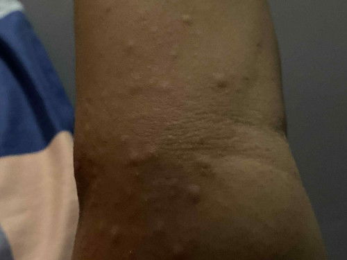 Hello po, ask lang as a first time mom. Normal lang po ba ang rashes sa buntis? 22weeks pregnant po.