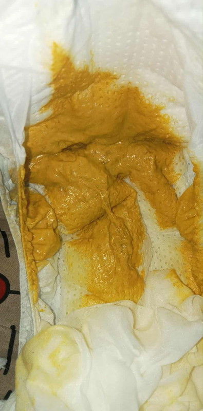 อึแบบนี้ปกติไหมคะ