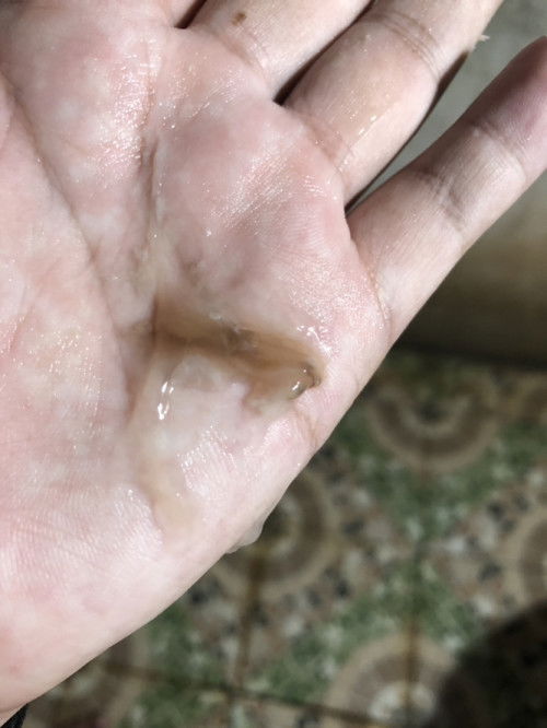 38วีคแล้วมีมูกสีน้ำตาลออกแบบนี้ควรไปโรงบาลมั้ยคะ มีอาการปวดท้องคล้ายประจำเดือนค่ะไม่มากไม่มีท้องปั้นแข็งหน่วงๆท้องน้อยนิดหน่อยค่ะ