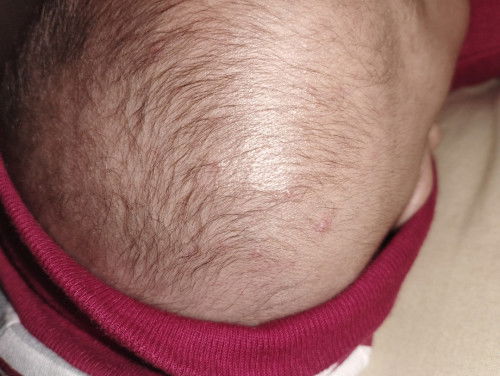 Bentol bentol Di kepala