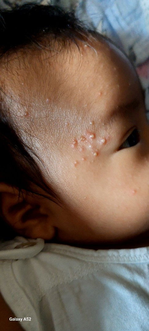 Baby acne/pimples