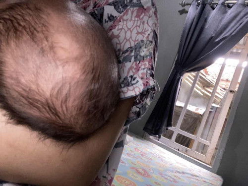 Bercak putih dikepala bayi