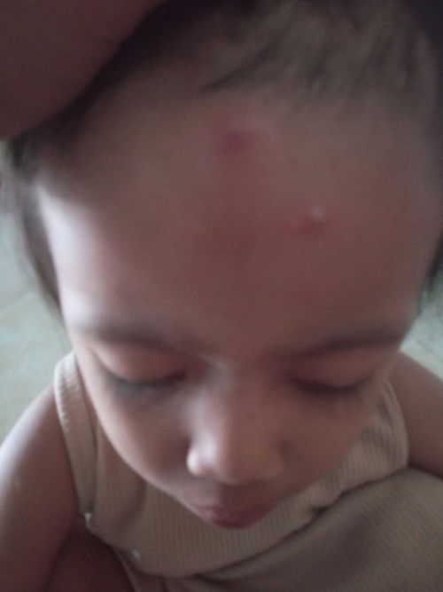 Bun mau tanya salep apa yang cocok buat anak saya soalnya ada seperti nana di atas alis