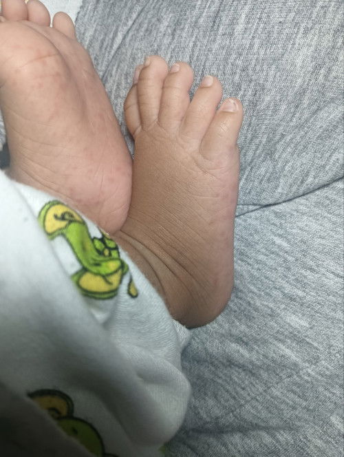 เป็นผื่นไม่มีเม็ดมีตุ่ม