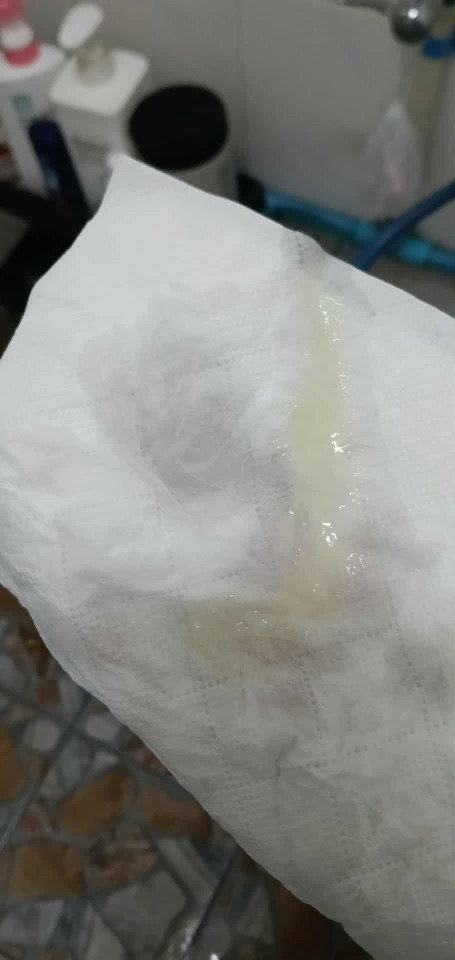 23+4w มีแบบนี้คืออะไรคะเเม่ๆ พึ่งเคยเป็นครั้งเเรกค่ะ🥲 แต่ไม่มีอาการปวดท้องค่ะ