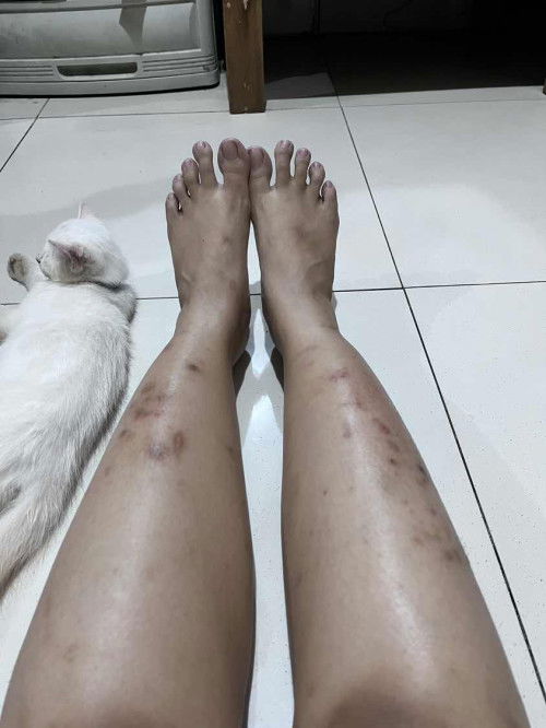 Dari awal hamil kaki pada gatal