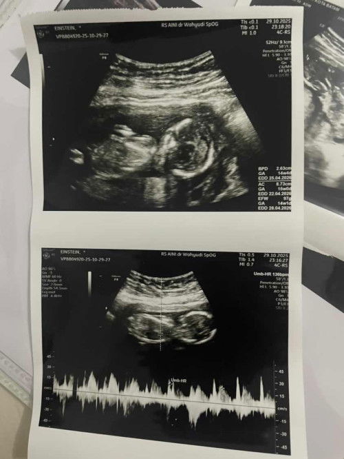 Apakah bayi saya normal?