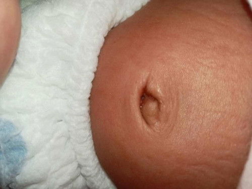 ขออนุญาตสอบถามค่ะสะดือหลุดแต่ไม่แห้งแฉะมีหนอง