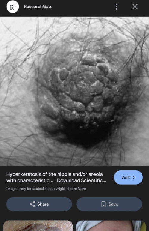 Nipple mcm crack berkeruping