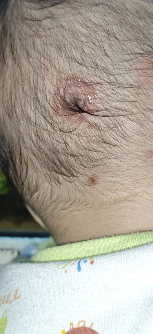 Ruam merah sudah 5 hari bentuknya seperti ini, kira2 salepnya apa ya, untuk jamur atau bukan