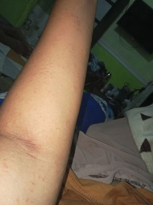 Kayak gini gatel kenapa ya bund a