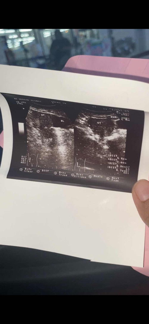 อายุ9วีคไม่เจอถุงตั้งครรภ์