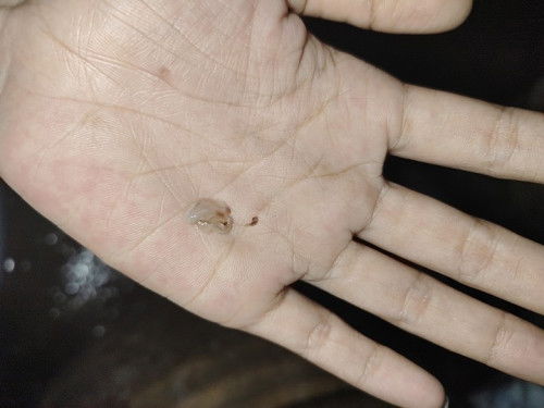 เมื่อวานมีมูกขาวป่นน้ำตาลออกมา