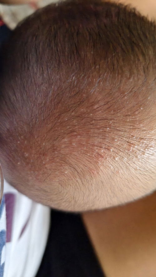 ตุ้มเล็กๆแข็งๆขึ้นบนหัว