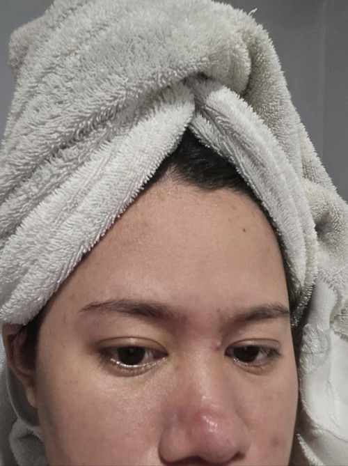 Hi mga sis, may recommendation ba kayo for acne during pregnancy.  2nd tri na po ako. Thanks!