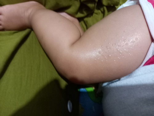 Normal gak ya ini keringatnya bun? Bayi 5 bln setiap dbf sealu keringat bnyk bngt sebiji2 jagung