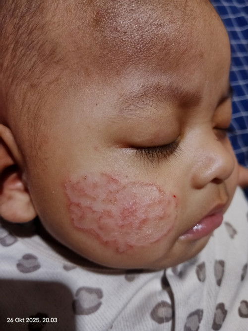 Ruam asi di pipi