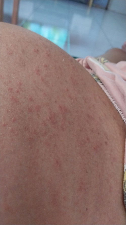 Bund...ada yang sama gak perut muncul bintik merah + gatal banget sekarang lagi hamil 34 weeks