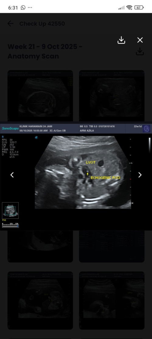 Lebihan otot di jantung baby