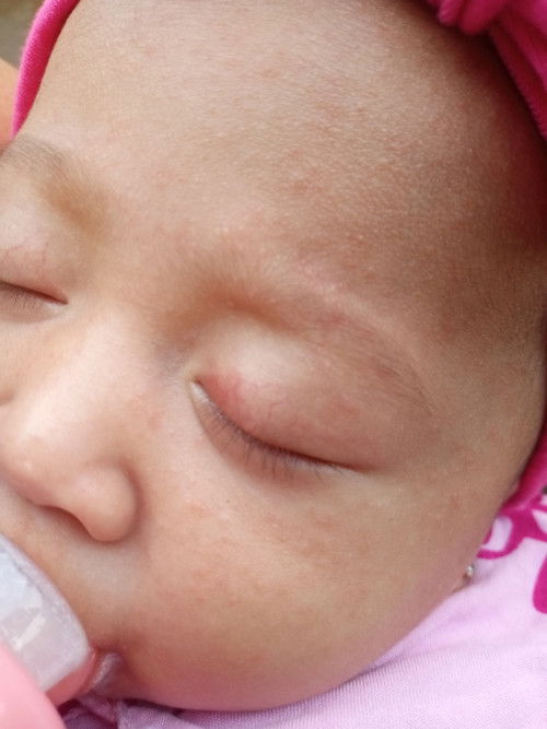 Bintik merah pada wajah