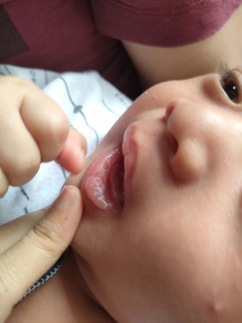 Solusi untuk mengatasi putih-putih dibibir