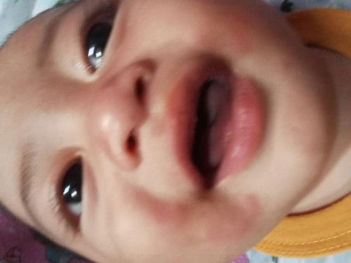 Bentol merah di seluruh badan