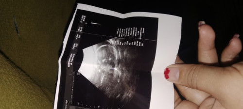 Janin melintang dan plasenta dibawah