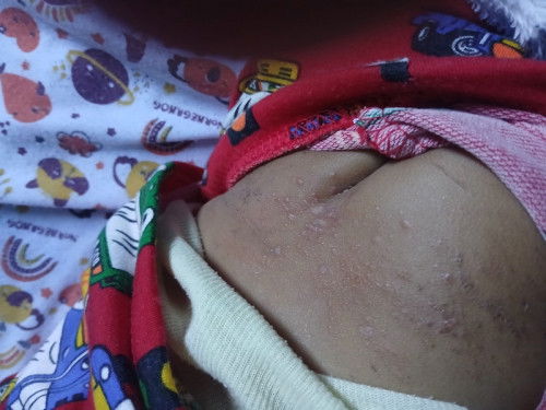 Mau tanya bun kalo pantat bayi usia 8 bulan kayak gitu penyebabnya apa dan obatin pake apa ya bun