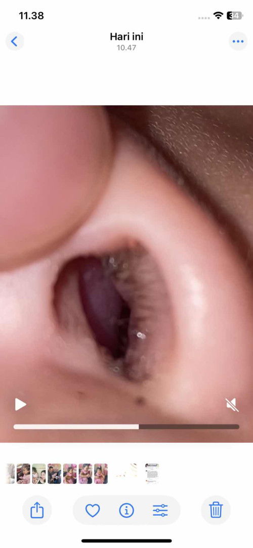 Hidung anak sebelah kiri