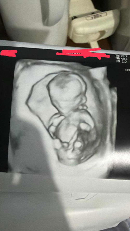 อายุครรภ์14+5