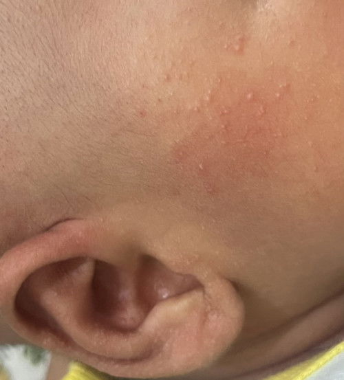 Ruam susu? Ruam panas?