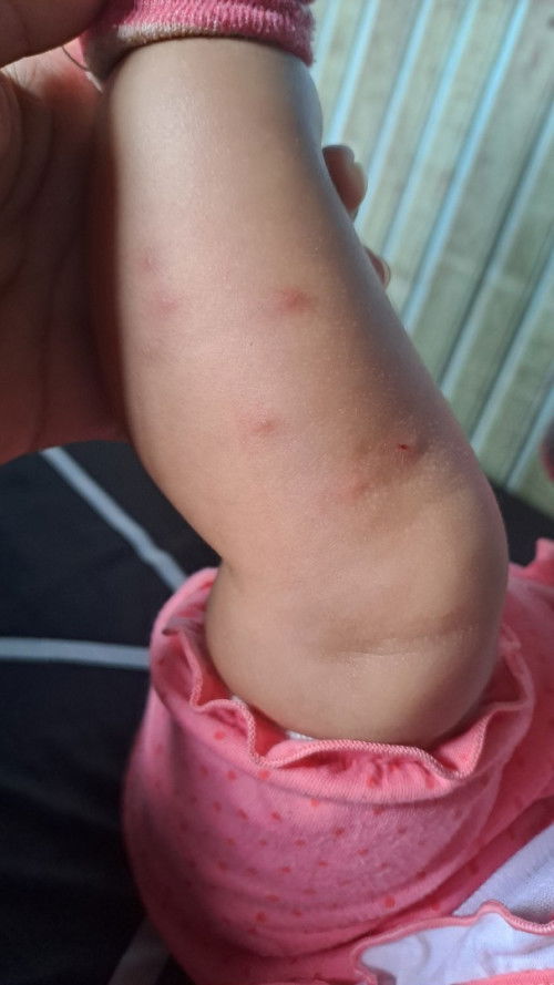 Bekas gigitan nyamuk/serangga