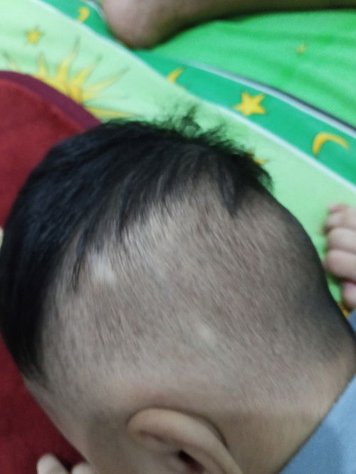 Bayi 3 bulan rambut nya tiba tiba pitak