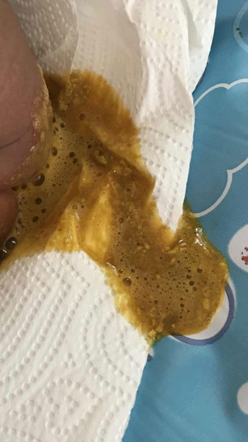 สอบถามค่ะแบบนี้ลูกท้องเสียไหมคะ