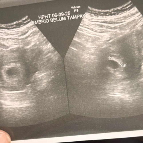 Janin belum terlihat di usg 8 minggu