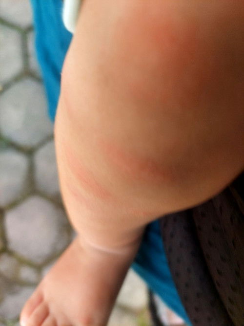 Ini Digigit serangg atau alergi ya bun ?