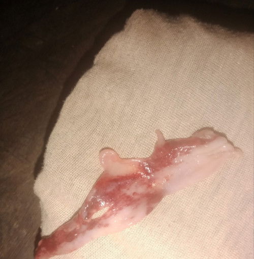 Keluar gumpalan pasca suntik kb 3 bulan