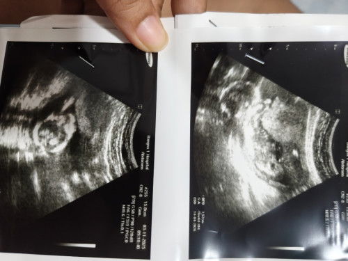 17 สัปดาห์ รู้เพศชัดมั้ยคะ