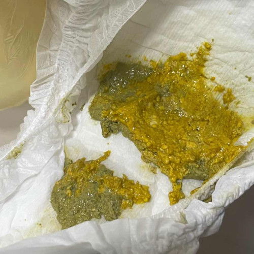 Warna feses hijau dan kuning